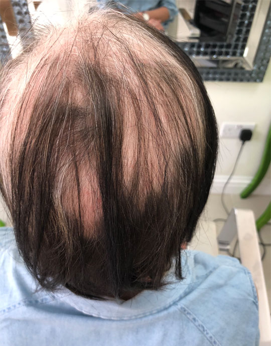 Hair InXs Womens Hair Loss Transformation Before