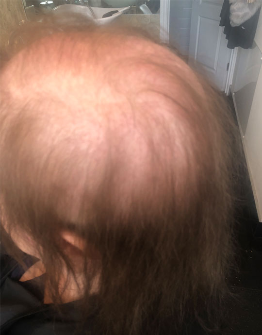 Hair InXs Salon Womens Hair Loss Before Transformation