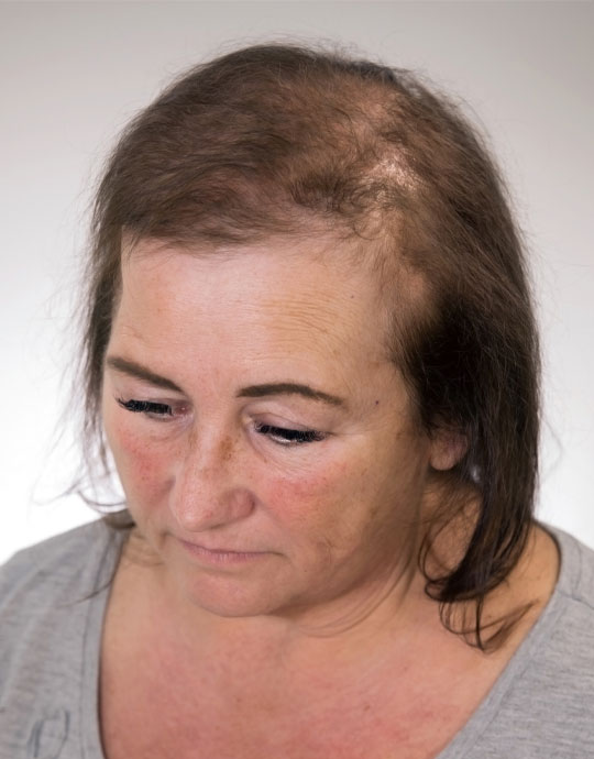 Hair InXs Salon Womens Hair Loss Before Transformation
