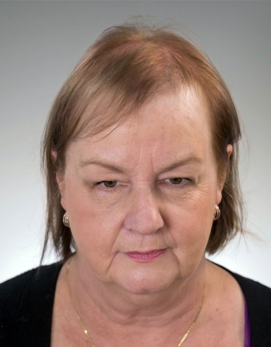 Hair InXs Salon Womens Hair Loss Before Transformation