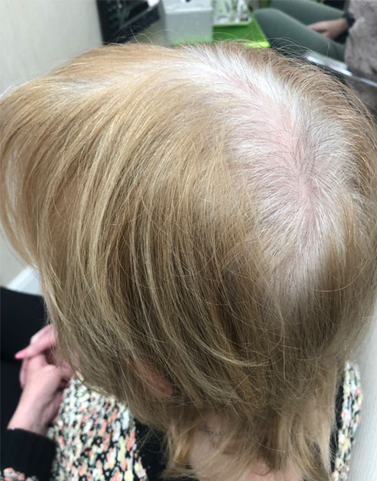 Hair InXs Salon Womens Hair Loss Before Transformation