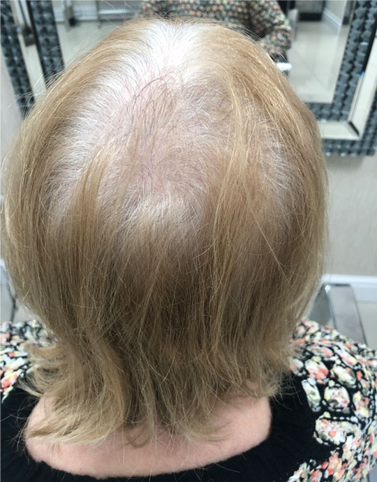 Hair InXs Salon Womens Hair Loss Before Transformation